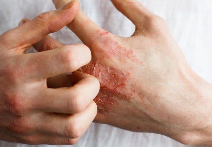 5 Eczema Types To Familiarize Yourself With