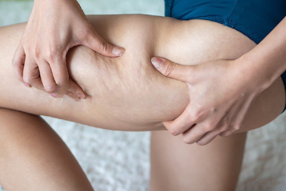 Still Frustrated With Your Cellulite Legs?