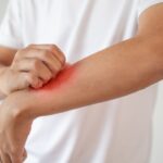 5 Natural Ways To Combat Eczema